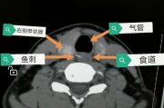 鱼刺卡食道怎么办（解决鱼刺卡食道的实用技巧）