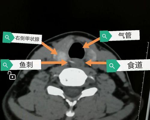 鱼刺卡食道怎么办（解决鱼刺卡食道的实用技巧）