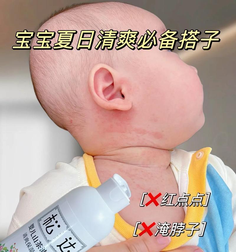 夏天长痱子怎么办？有效预防和治疗痱子的方法是什么？